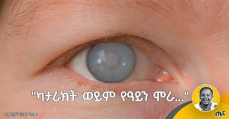 ካታራክት የምንለው የሕመም ስሜት የሌለውና ሌንስ …