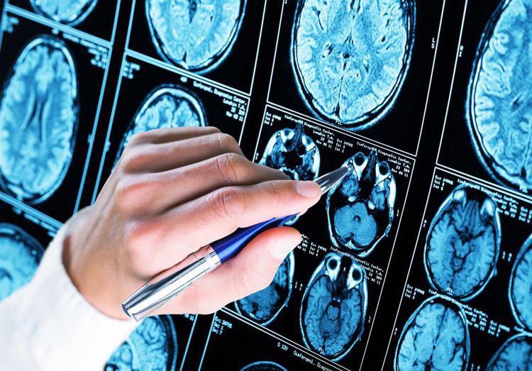 Alzheimer, lo studio: mortalità più bassa …