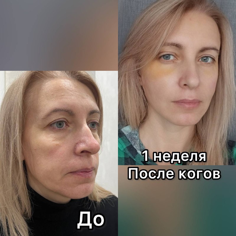 Неделя после круговой подтяжки лица ***🥰***