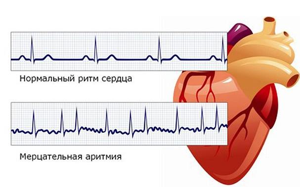 **Аритмия — это болезнь сердца, но …