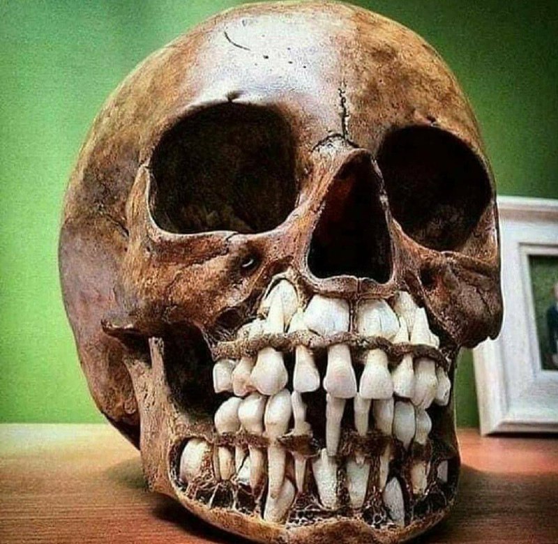 A picture of the baby's skull …