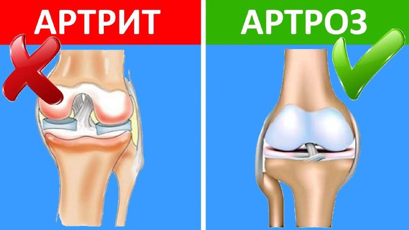 [**#Диққат**](?q=%23%D0%94%D0%B8%D2%9B%D2%9B%D0%B0%D1%82)[**#ДОЛЗАРБ**](?q=%23%D0%94%D0%9E%D0%9B%D0%97%D0%90%D0%A0%D0%91)***🟢*****Бўғим оғриқларидан 3 кунда батамом