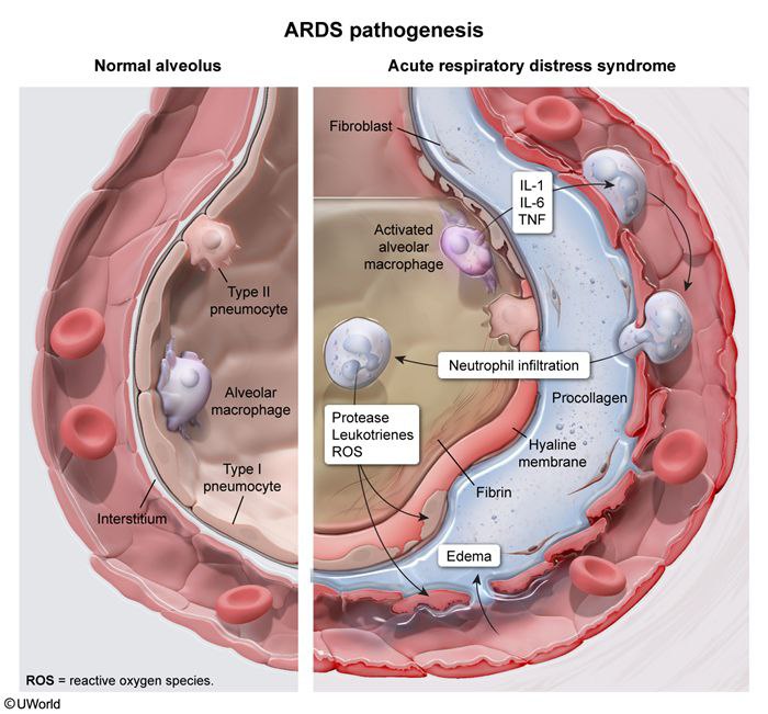 ARDS (Acute Respiratory Distress Syndrome) is …