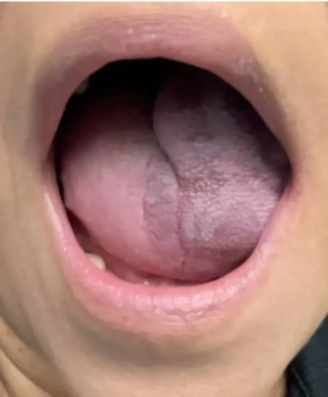 ‏Venous vascular malformation of the tongue