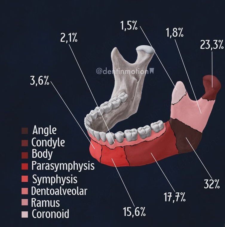 *****?***| Most frequent area of mandibular …