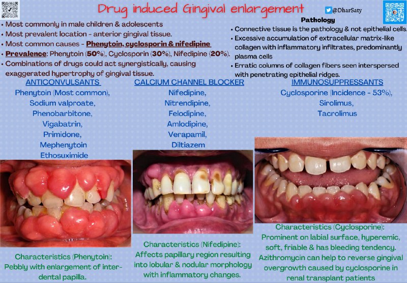 **Drug-induced gingival Enlargement: