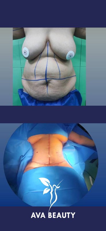 عمل زیبایی لیپو ساکشن ۳۶۰درجه و …