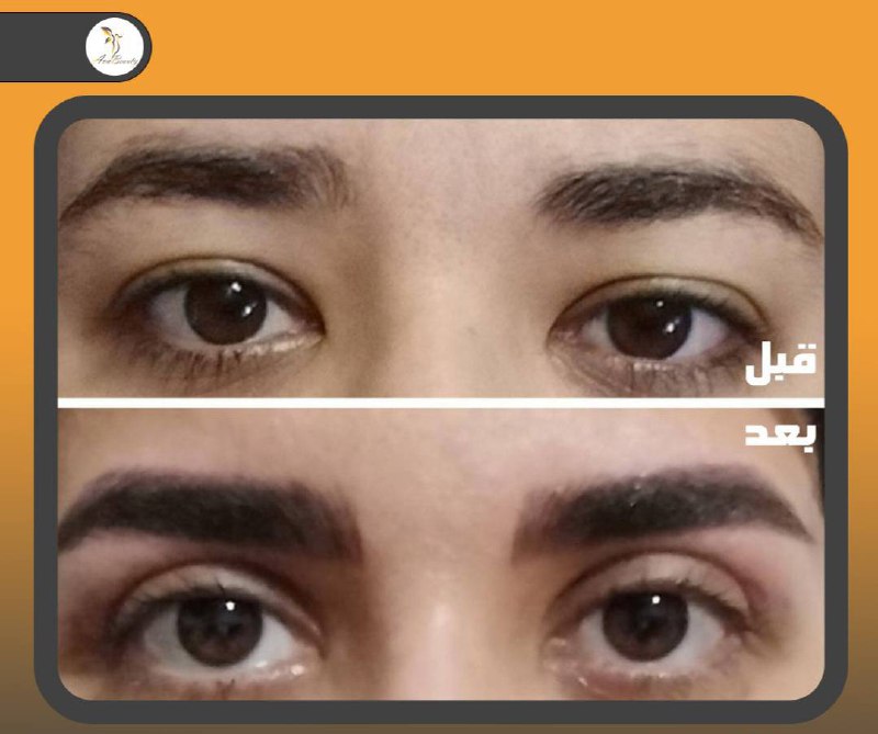 بلفاروپلاستی جراحی پلک برای برداشتن پوست …