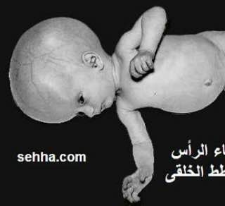 مولودة مصابة باستسقاء الراس نتيجة الاصابة …
