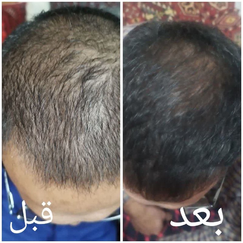 مصرف یه دوره قطره الن بیوتی …