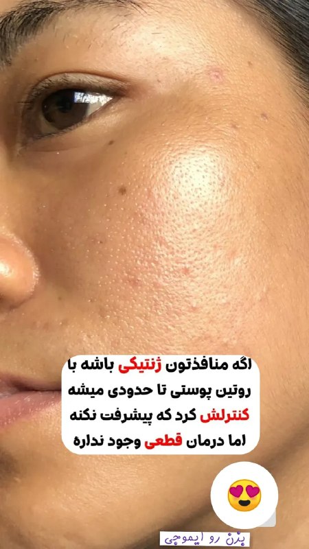 اگه منافذتون ژنتیکی باشه باروتین پوستی …