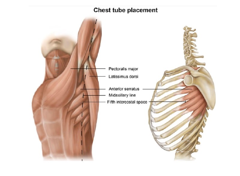 Chest tube insertion: -