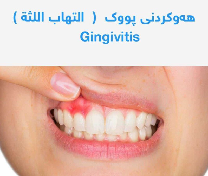 هەوکردنی پووک Gingivitis