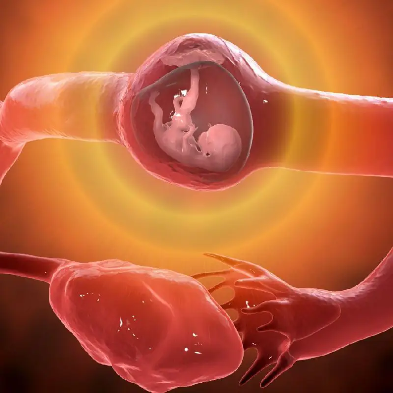 درمان بارداری اکتوپیک (EP) در بیشتر …