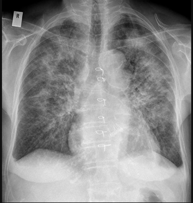 Alveolar oedema - Bat's wing pattern