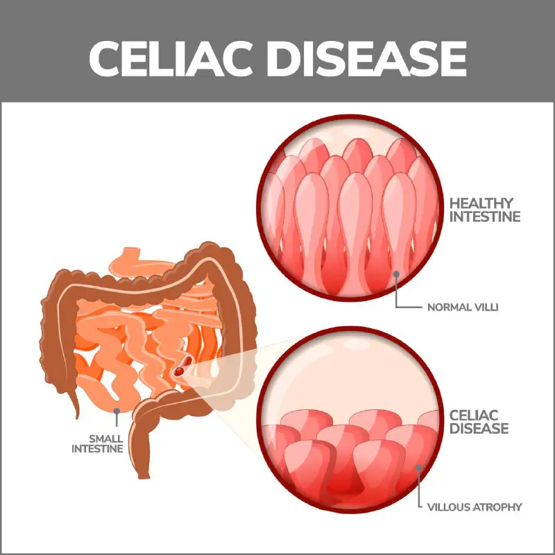 **Celiac disease (gluten-sensitive enteropathy) classically presents …