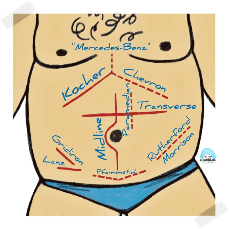 NAME of incision in abdominal operation