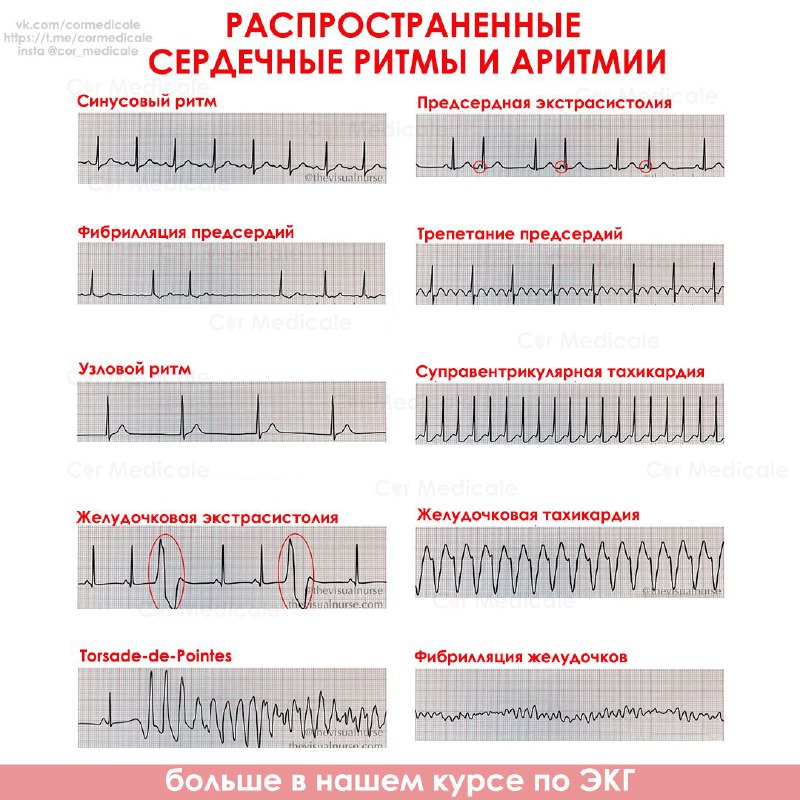 Распространенные сердечные ритмы и аритмии