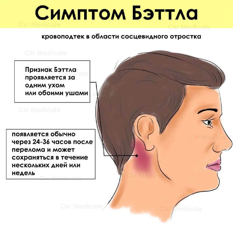 Симптом Бэттла — кровоподтек (экхимоз) в …