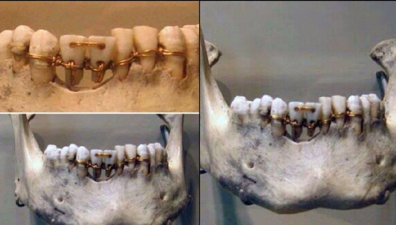 *Impresionante trabajo dental encontrado en una …