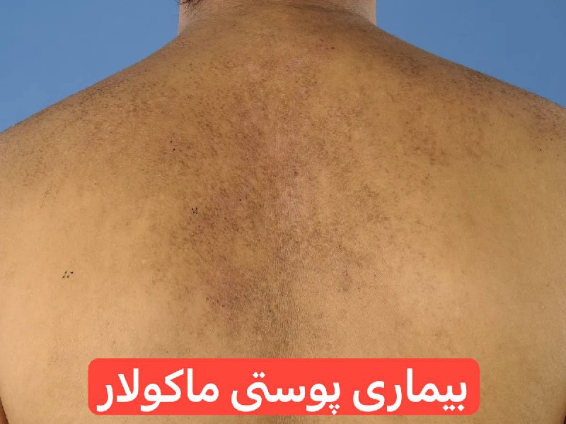 ***✅*** بيمارى پوستى ماكولار