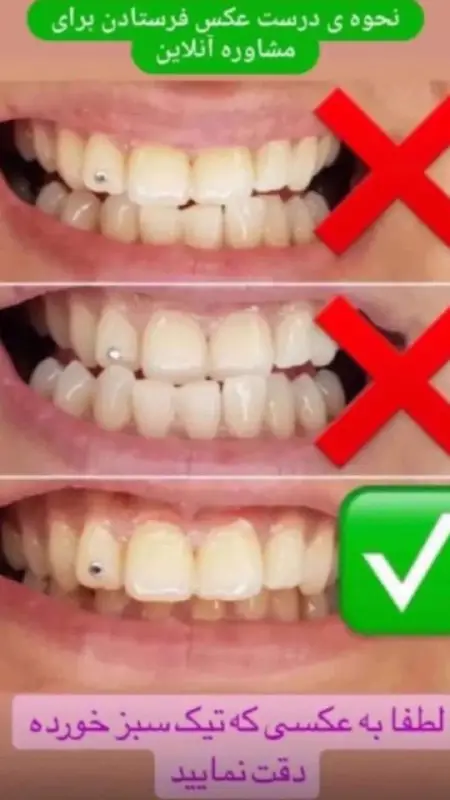 Dental_Composit