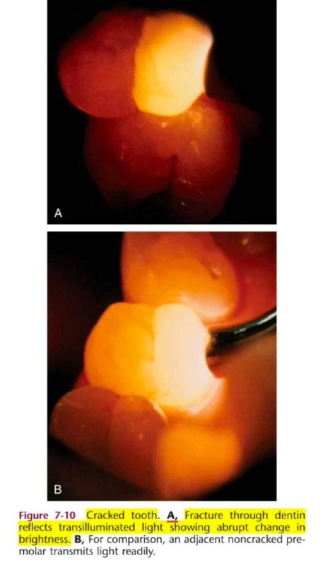 [*****💡***|How to diagnose cracked tooth ***💯*****](http://t.me/dentist1001)