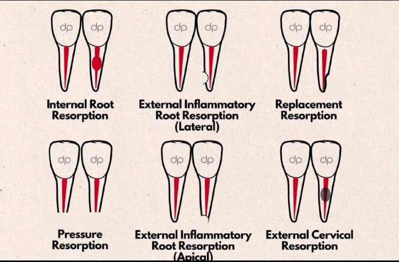 ***💡***| Types of resorption***✔️***