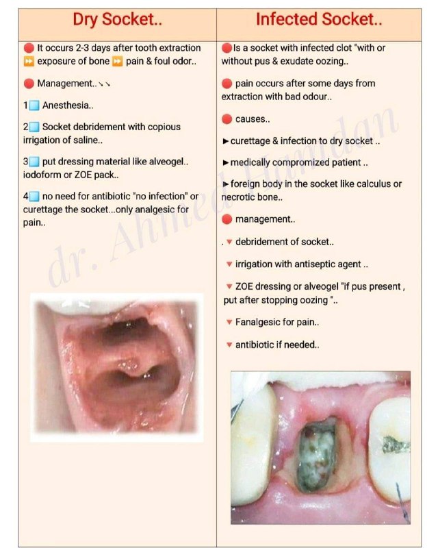 **Dry Socket &amp; Infected Socket**