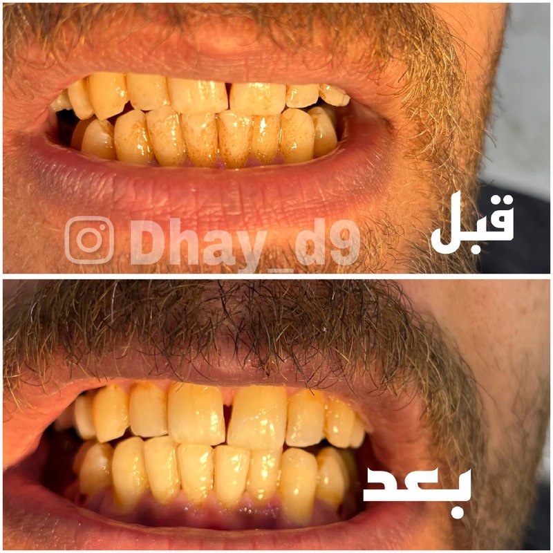 كيسات اليوم