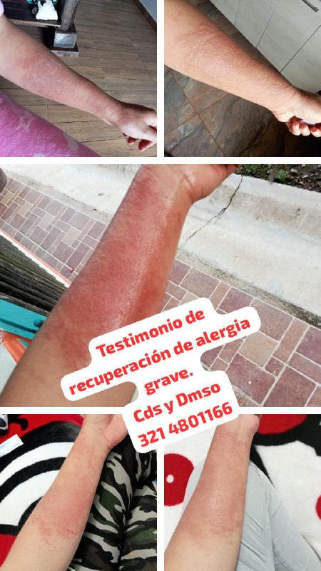 Testimonio de recuperación de alergia grave …