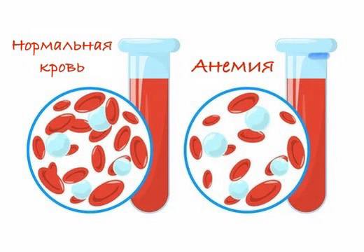 Сегодня поговорим про **железодефицитную анемию**