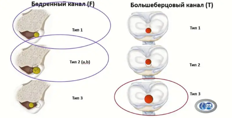 ***➖***тип ***1️⃣*** каналов на бедренной кости: …