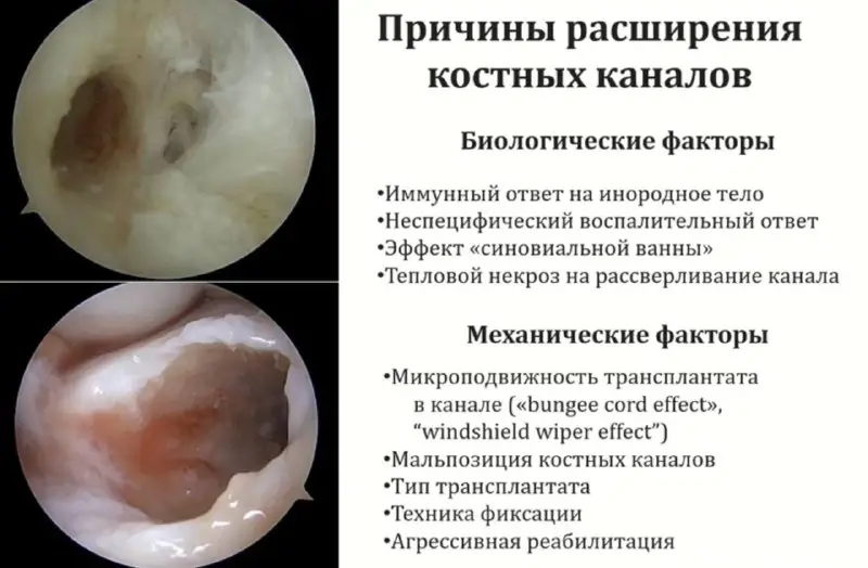 ***🔷***Причины расширения костных каналов