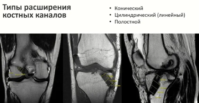 ***🔷***Типы расширения костных каналов