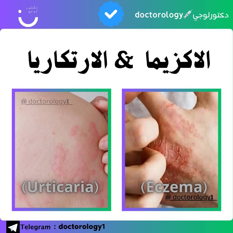 الإكزيما (Eczema) والأرتكاريا (Urticaria) هما حالتان …