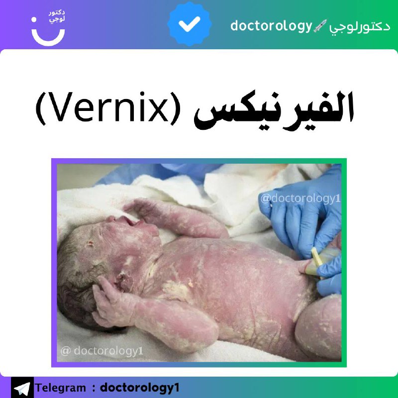 الفيرنيكس (Vernix)