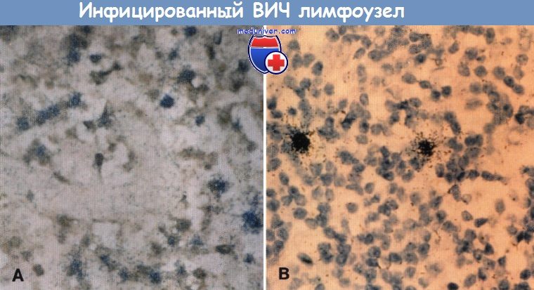 Количество CD4-лимфоцитов инфицируемых ВИЧ