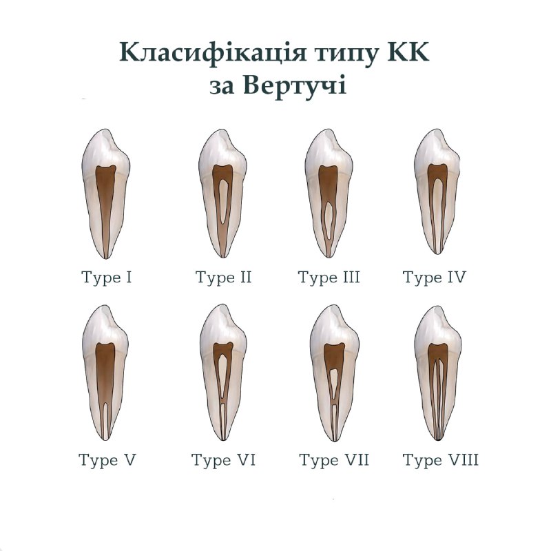 **Vertucci виділяє 8 типів конфігурацій кореневих …