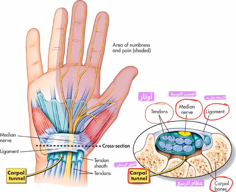 **{متلازمة النفق الرسغي carpal tunnel syndrome …