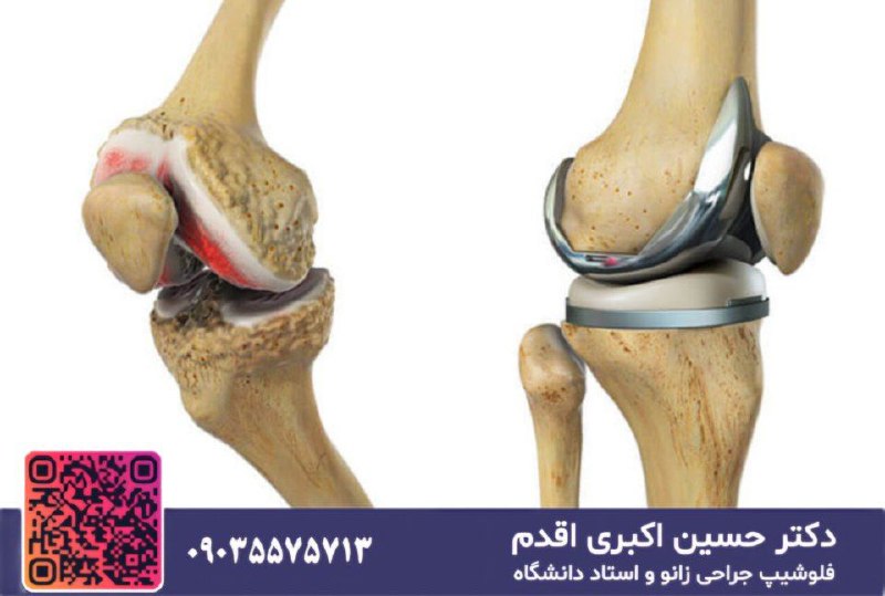 ***?***تعویض کامل زانو