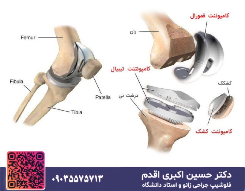 ***⛔️***جراحی تعویض کاسه زانو