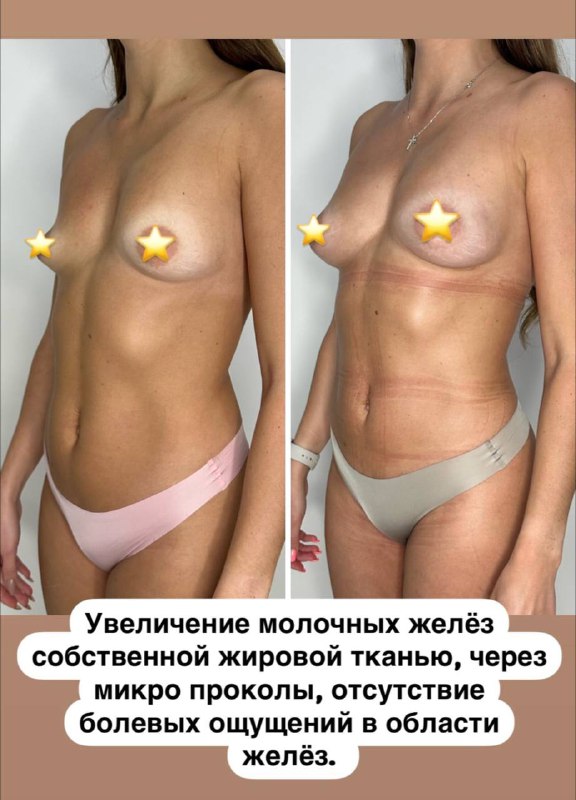 Что нужно знать об увеличении груди …