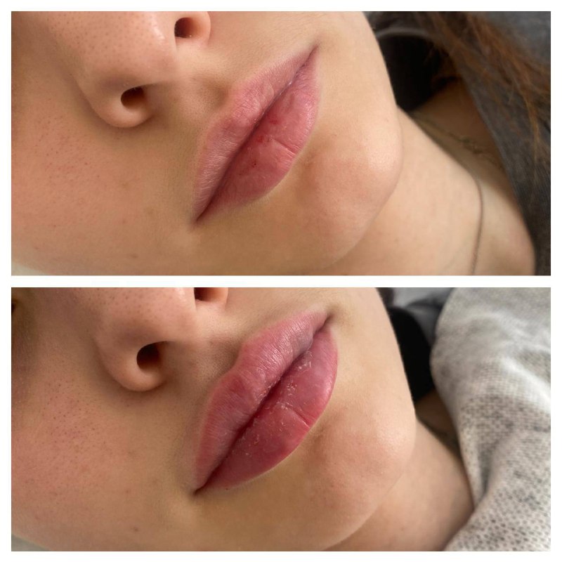 **Аугментация губ Juvederm Volift 1 мл.**