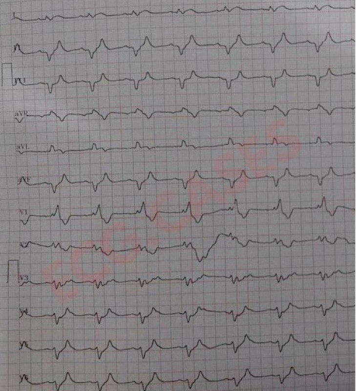 A 65-year-old male with a history …