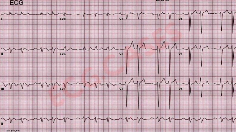 65 y female with fatigue and …