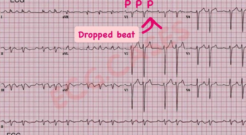 ECG.CASES