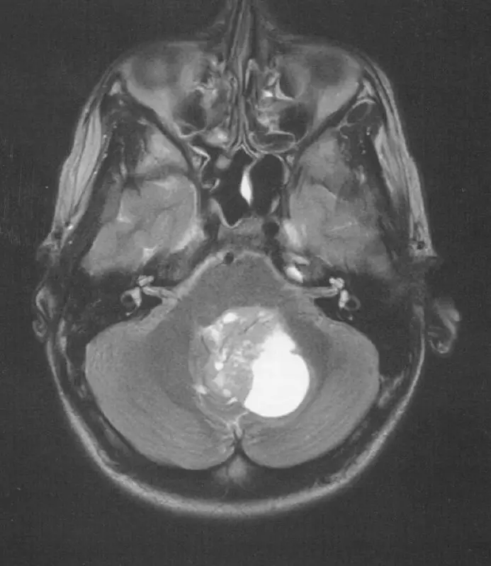 Meduloblastoma (cystic + solid components)