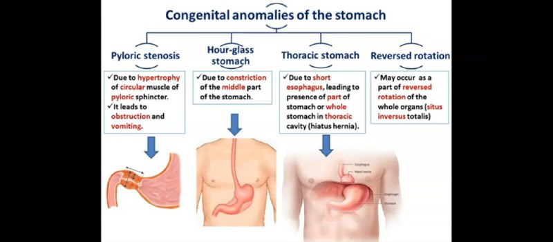 Congential anomalies of the stomach