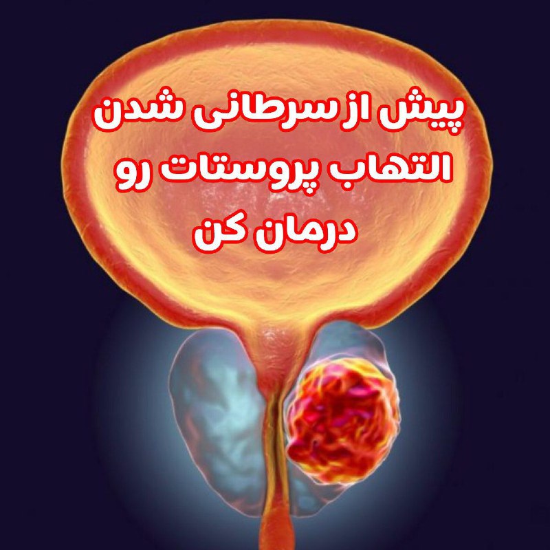 **التهاب پروستات با عدم بهبود ریشه‌ای …
